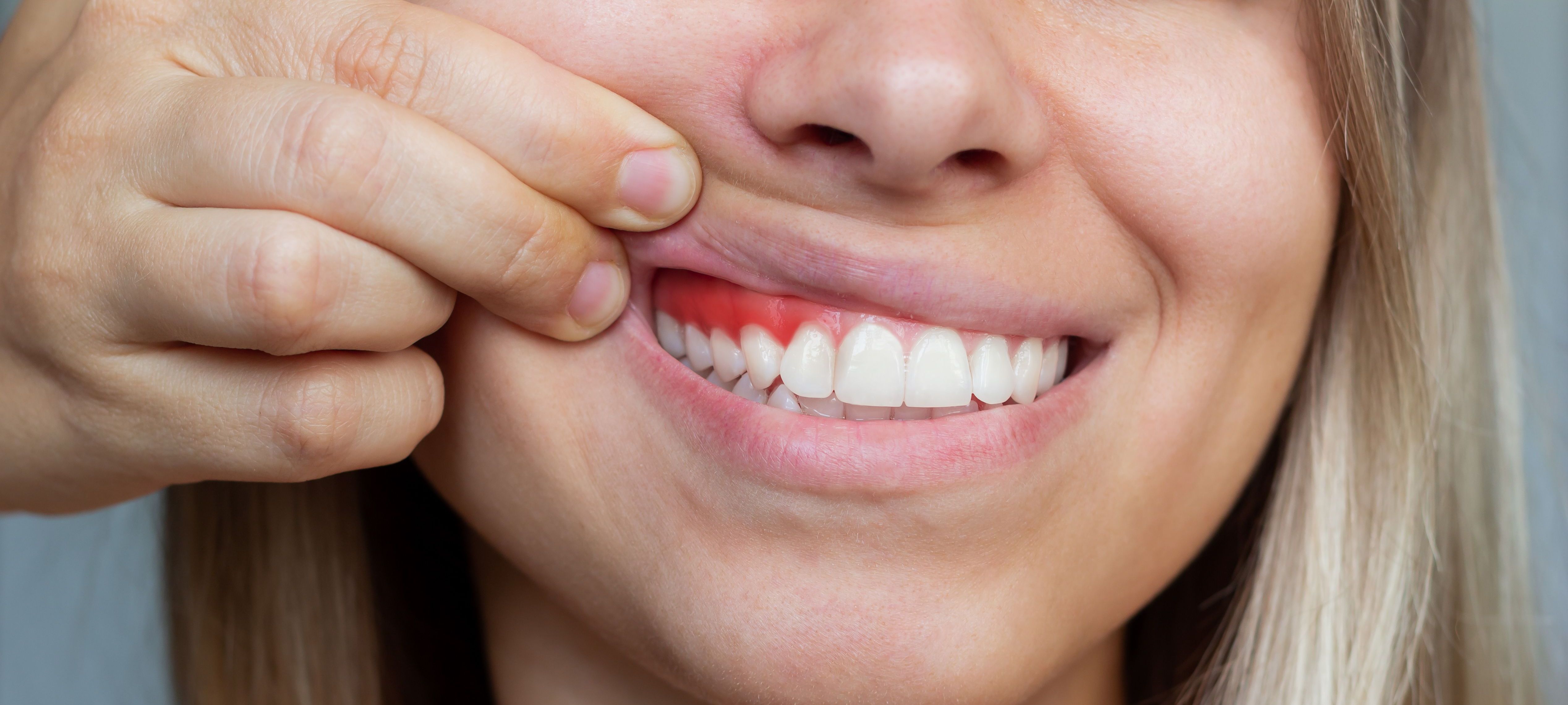 Aanbeveling Donder Volwassenheid Parodontologie bij Dentius | Dentius