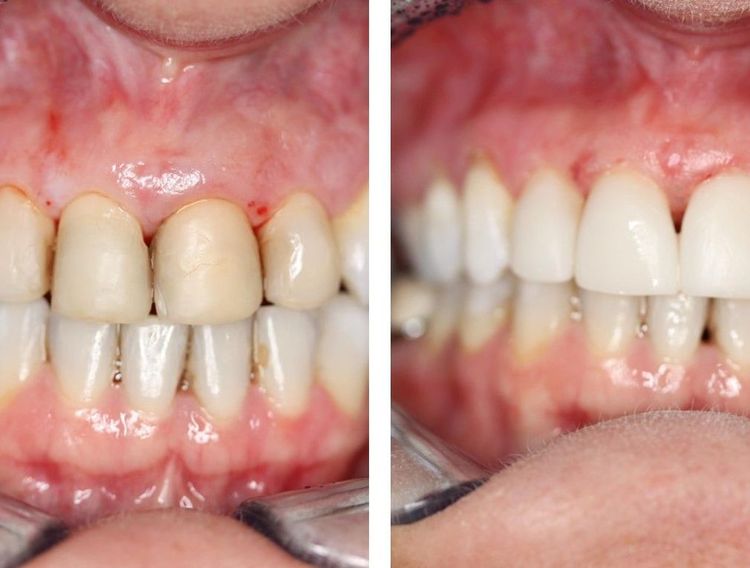 Dentius voor en na