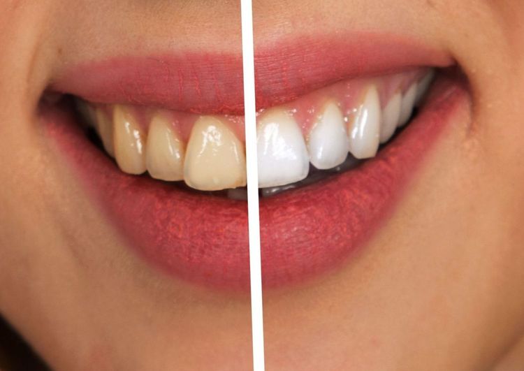 Dentius voor en na