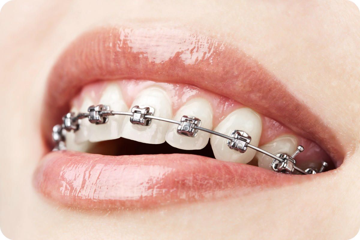 Orthodontie bij Dentius Dentius